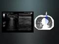 Pulmonary Ultrasound in Dyspnea