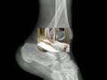 Dislocation Reduction Ankle (sample) - proceduresconsult.com