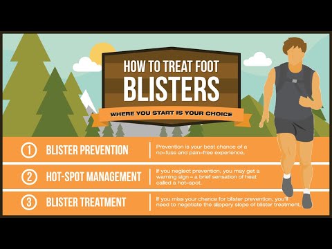 how to treat running blisters