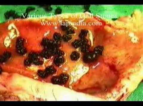 Gall Bladder Stones Types - Lap Chole