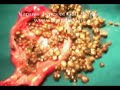 Gall Bladder Stones Types - Lap Chole