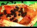 Gall Bladder Stones Types - Lap Chole
