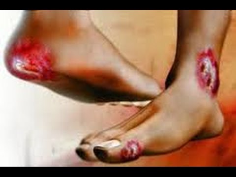 how to treat ketones