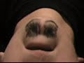 Mr. Chin has pimple problems Mr. Chin has pimple problems