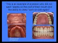Dental Implants| Replacing Dentures- |Glen Ellyn (near |Chicago)