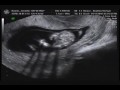 13 weeks 4 days Ultrasound