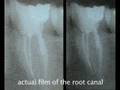 Root Canal Demonstration Final Film