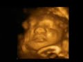 Sooe Baby 34 Weeks 3D 4D ultrasound