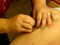 Gross Zit Popping #3
