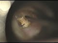 earwax 2