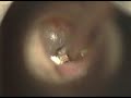 earwax 2 earwax 2