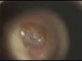 earwax 2