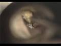 earwax 2