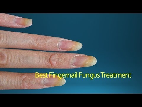 how to cure fingernail fungus