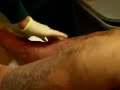 Lymphedema Therapy with Kristi