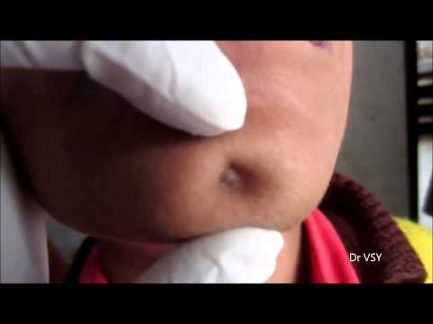 how to treat leukoplakia