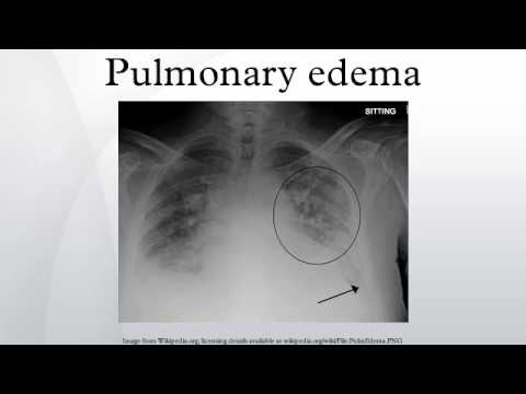 how to treat pulmonary edema
