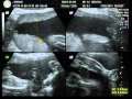 V�deo - J�lia com 28 semanas e 6 dias.