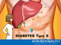 Diabetes - Animed He