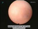 hysteroscopy - vision of the womb