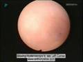 Hysteroscopy - Vision of the Womb