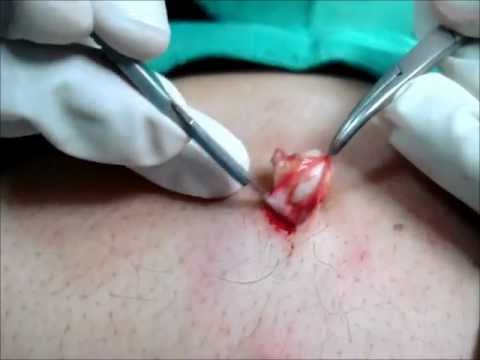 how to drain a cyst