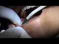 Wisdom Tooth Extraction - Jaw Bone Wisdom Tooth Extraction - Jaw Bone