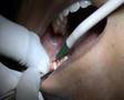 Wisdom Tooth Extraction - Jaw Bone