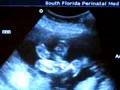 Twins Rodriguez-Rojas Ultrasound Sept. 3 2008 week 24