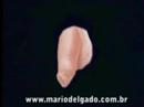Cirurgia de Fimose em 3D