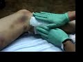 Ultrasound Guided Sclerotherapy Varicose Veins Training Vid Ultrasound Guided Sclerotherapy Varicose Veins Training Vid