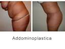Addominoplastica - Chirurgia estetica dell\ Addominoplastica - Chirurgia estetica dell\