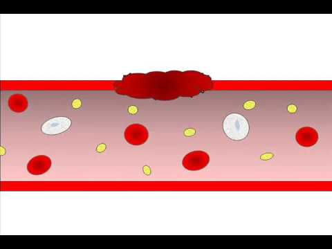 how to dissolve blood clots