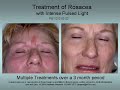 Rosacea