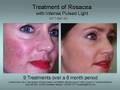 Rosacea