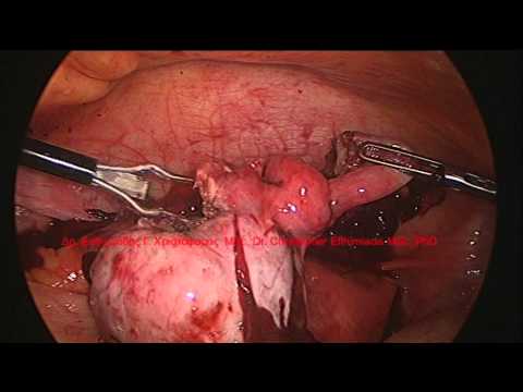 Ectopic pregnancy after IVF. Laparoscopic surgery II