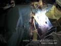 SILS Divison And Removal Of Uterus SILS Divison And Removal Of Uterus