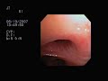 Lung Surgery 1: Bronchoscopy Lung Surgery 1: Bronchoscopy
