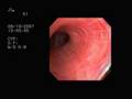 Lung Surgery 1: Bronchoscopy