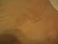 Wheelchair style, my surgery Cuts; L1 injury 8-10-11