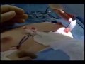 Breast Augmentation Video Breast Augmentation Video