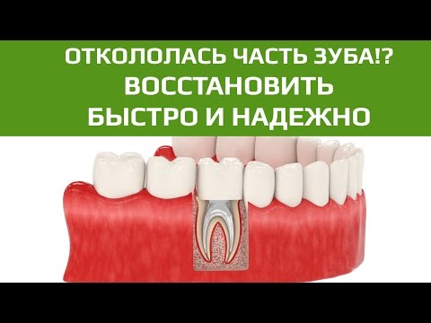 Клей для зубных коронок - обзор и инструкция по использованию
