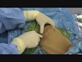 posterior portal shoulder arthroscopy posterior portal shoulder arthroscopy
