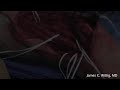 Distal Humerus Giant Cell Tumor Resection - Part 2