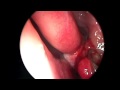 Removal of Sinus Granulation Removal of Sinus Granulation
