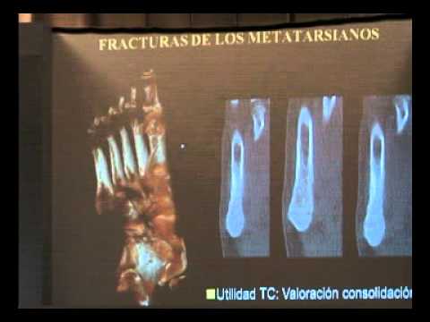 FRACTURAS DE LOS METATARSIANOS/ DR JOSÉ RAMÓN ALTONAGA/ dvd31 10