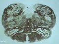 Medulla (Rostral Sensory Decussation)