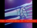 motor development story osteoperosis