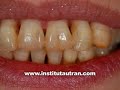 Est�tica dental: enc�as retra�das (problema y soluci�n)