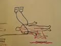 Hypovolemic Shock